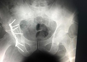 عملية جراحية معقدة وناجحة لكسر مفتت