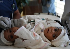 إجراء عملية فصل التوأم السيامي التنزاني الأحد المقبل بمدينة الملك عبدالعزيز الطبية