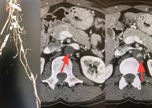 جراحة ناجحة لأربعيني بالخبر كاد أن يفقد الحركة