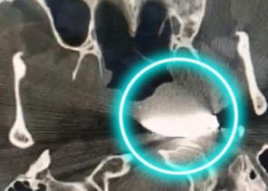 مقذوف مسماري يخترق وجه عامل خمسيني .. و”سعود الطبية” تنقذه