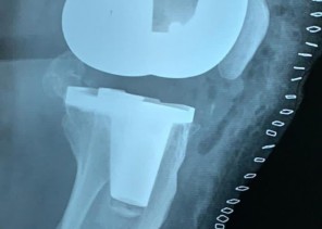 نجاح ثاني عملية استبدال مفصل ركبة مريضة في وادي الدواسر