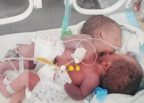 مركز الملك سلمان للإغاثة يستجيب للحالة الإنسانية للتوأم السيامي اليمني في مستشفى السبعين بصنعاء