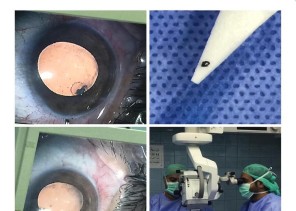 استشاريون بعيون جدة يستخرجون بقايا مسمار