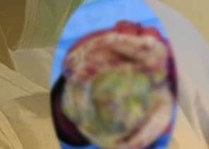 مستشفى دومة الجندل ينهي معاناة مريضة من ورم ليفي وزنه 3 كجم