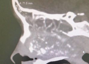 فريق الأنف والأذن والحنجرة الجراحي بمستشفى الملك فهد المركزي بجازان ينجح في استئصال ورم سرطاني نادر من جمجمة طفلة
