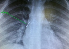 فريق طبي ينجح بإنقاذ طفلة استنشقت “دبوس” بسكاكا