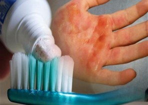 “الصحة الخليجي”: علاج الحروق بمعجون الأسنان “شائعة”.. وهذه طريقة العلاج الصحيحة