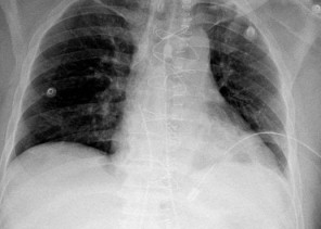 “سعود الطبية” تنقذ مقيمًا تعرض للإصابة في القلب