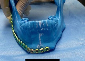 “تخصصي تبوك” يتمكن من إعادة بناء فك مريض