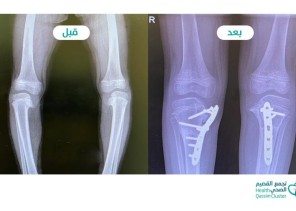 ولادة بريدة تنجح في علاج طفلة من تقوس شديد بالساقين