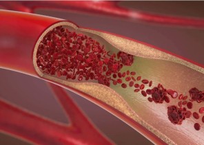 “خطر في آخر أيام رمضان”.. استشاري أوعية دموية يحذر من سبب مفاجئ لجلطات الشرايين (شاهد)