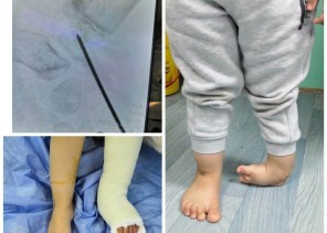 إنهاء معاناة طفل من تشوه بالقدم