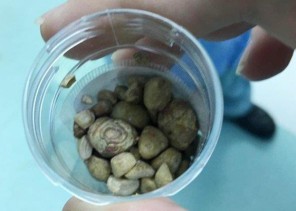 بعد معاناة استمرت 6 سنوات.. أطباء بمستشفى القريات يخرجون 87 حصوة من مثانة سبعيني