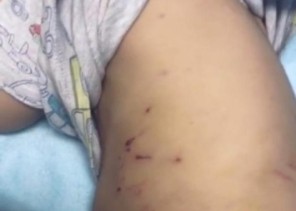 هجوم شرس لكلاب ضالة على طفل بالأحساء .. والأمانة تعلن عن تحرك عاجل