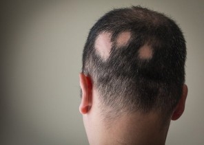 هل «الثعلبة» مرض مُعدٍ؟