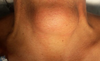 نجاح عملية إستئصال ورم في الرقبة