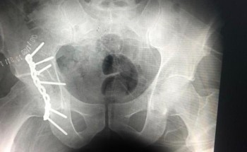 عملية جراحية معقدة وناجحة لكسر مفتت