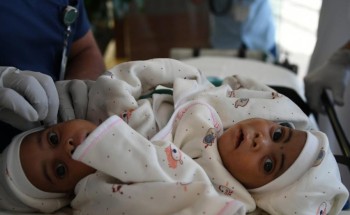 إجراء عملية فصل التوأم السيامي التنزاني الأحد المقبل بمدينة الملك عبدالعزيز الطبية