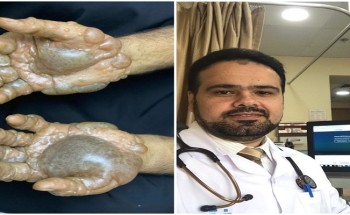 تورم يدي شاب بسبب المعقمات وارتداء القفازات .. وطبيب مختص بجدة يكشف لـ”الشمال” الحقيقة!