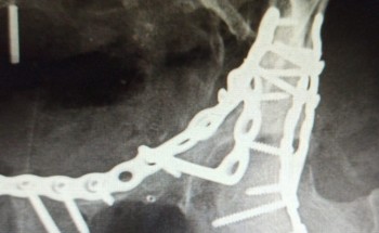 “سعود الطبية” تواصل نجاحاتها في العمليات المعقدة.. وتنقذ أربعينية من إعاقة بالحركة