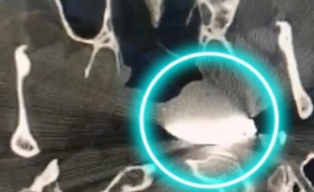 مقذوف مسماري يخترق وجه عامل خمسيني .. و”سعود الطبية” تنقذه