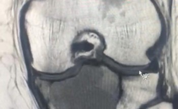 فريق طبي ينجح في استئصال ورم في عظمة ساق مريضة في مستشفى المدينة المنورة