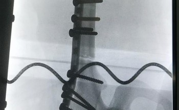 جراحة معقدة لحالتي العظم الرخامي في مستشفى الدوادمي العام