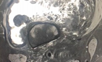 بدء العمل في جراحة أورام العظام والعضلات في مستشفى المدينة المنورة