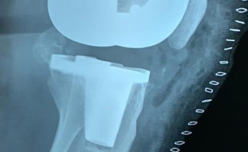 نجاح ثاني عملية استبدال مفصل ركبة مريضة في وادي الدواسر