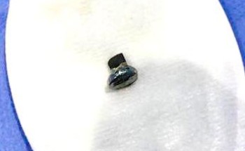 فريق طبي في مستشفى العيون بجدة يتمكن من  استخراج جزء مكسور من مسمار صلب داخل عين مريض