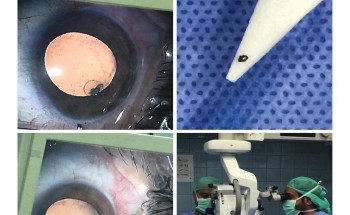 استشاريون بعيون جدة يستخرجون بقايا مسمار