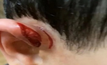 تعرض طفل للإفتراس من ذئب في الأفلاج