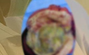 مستشفى دومة الجندل ينهي معاناة مريضة من ورم ليفي وزنه 3 كجم