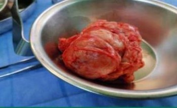 مستشفى صوير العام ينهي معاناة سيدة من ورم ليفي وزنه ٥٠٠ جم