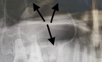 تدخل طبي ناجح في مستشفى القريات العام لإستئصال ورم من الفك العلوي لمريض