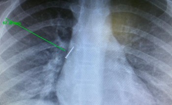 فريق طبي ينجح بإنقاذ طفلة استنشقت “دبوس” بسكاكا