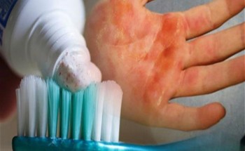 “الصحة الخليجي”: علاج الحروق بمعجون الأسنان “شائعة”.. وهذه طريقة العلاج الصحيحة