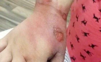 والد “الطفلة المحترقة بالقهوة” يعفو عن المتسببين في الواقعة قبل صدور نتائج التحقيق