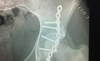 نجاح عملية جراحية لكسر بالجوف المفصلي بالقريات