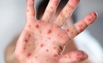 وزارة الصحة تعلن انطلاق الحملة الوطنية للتطعيم ضد الحصبة