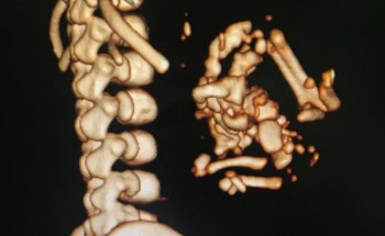 حالة نادرة.. ولادة حية لـ”جنين داخل جنين” بمستشفى “الهدا العسكري” بالطائف