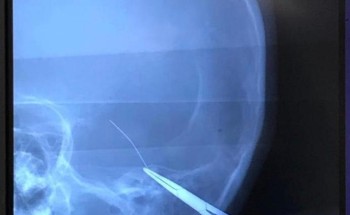 استخراج “إبرة خياطة” من رأس طفل بمستشفى القريات