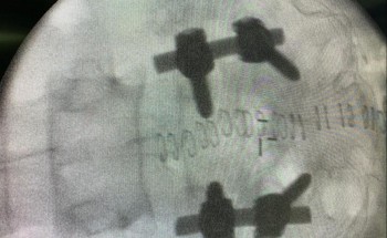 مركزي حفرالباطن يثبت الفقرات “لأربعيني” يعاني من انزلاق عجزي من الدرجة الثانية