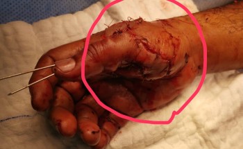 إعادة أصبع مريض باستخدام المجهر الجراحي بـ”سعود الطبية”