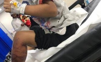 والد الطفل الملسوع يفند ادعاءات “صحة جازان” بأنه أخرج ابنه من المستشفى قبل اكتمال علاجه