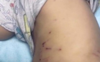 هجوم شرس لكلاب ضالة على طفل بالأحساء .. والأمانة تعلن عن تحرك عاجل