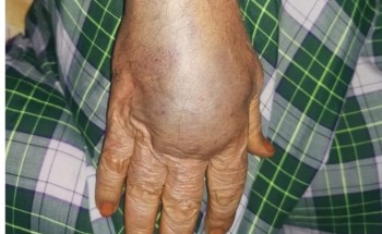 شاهد ماحدث ليد مُسن بعد سحب عينة دَم منه بمستوصف بجازان.. والصحة: نحقق في الشكوى