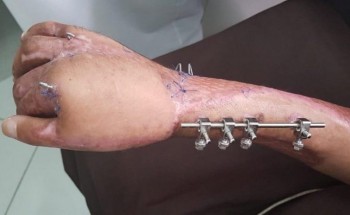 جدة.. إنقاذ يد شاب من البتر بمستشفى الملك عبدالعزيز