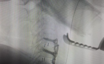 تدخل جراحي ناجح ينهي معاناة سيدة من الانزلاق الغظروفي بحفرالباطن