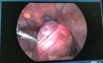 نجاح اول عملية استئصال ورم لمريضة في مستشفى املج العام
